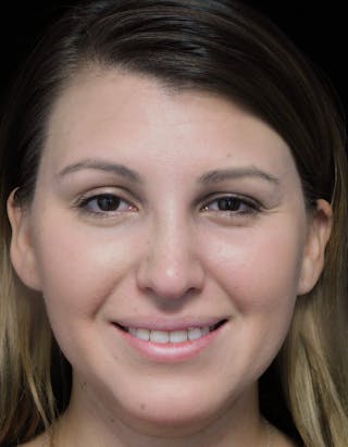 Beverly Hills Rhinoplasty Before & After Gallery - Patient 244001 - Image 6 Dr. Deepak Raj Dugar