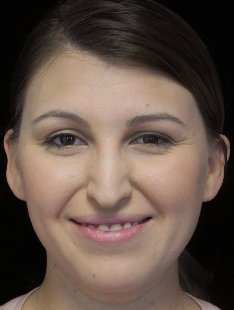Beverly Hills Rhinoplasty Before & After Gallery - Patient 244001 - Image 5 Dr. Deepak Raj Dugar
