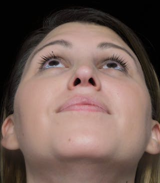 Beverly Hills Rhinoplasty Before & After Gallery - Patient 244001 - Image 8 Dr. Deepak Raj Dugar