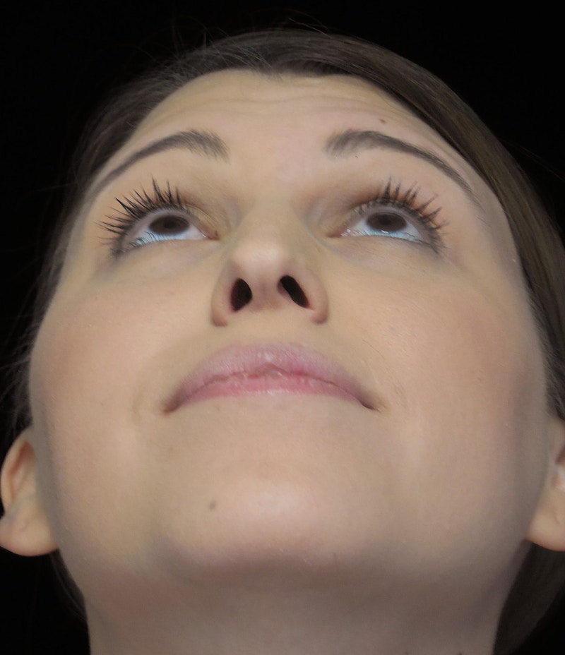 Beverly Hills Rhinoplasty Before & After Gallery - Patient 244001 - Image 7 Dr. Deepak Raj Dugar
