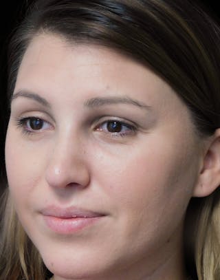 Beverly Hills Rhinoplasty Before & After Gallery - Patient 244001 - Image 10 Dr. Deepak Raj Dugar