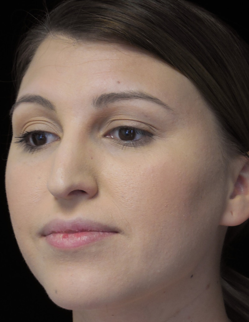 Beverly Hills Rhinoplasty Before & After Gallery - Patient 244001 - Image 9 Dr. Deepak Raj Dugar
