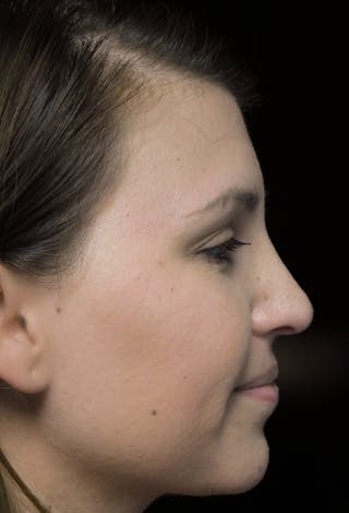 Beverly Hills Rhinoplasty Before & After Gallery - Patient 244001 - Image 2 Dr. Deepak Raj Dugar