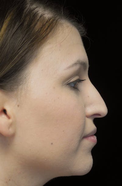 Beverly Hills Rhinoplasty Before & After Gallery - Patient 244001 - Image 1 Dr. Deepak Raj Dugar