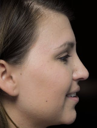 Beverly Hills Rhinoplasty Before & After Gallery - Patient 244001 - Image 12 Dr. Deepak Raj Dugar