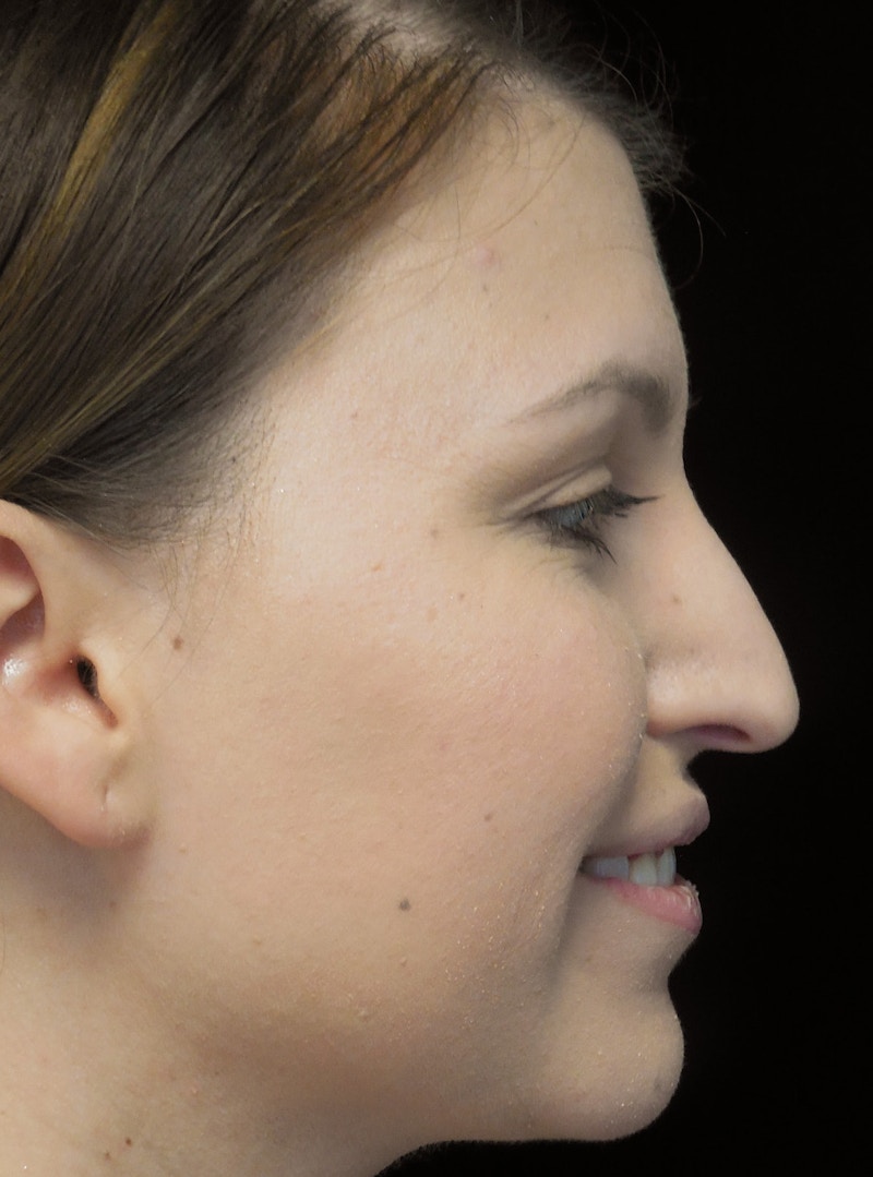 Beverly Hills Rhinoplasty Before & After Gallery - Patient 244001 - Image 11 Dr. Deepak Raj Dugar