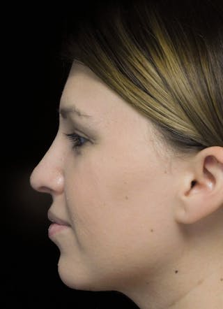 Beverly Hills Rhinoplasty Before & After Gallery - Patient 244001 - Image 14 Dr. Deepak Raj Dugar