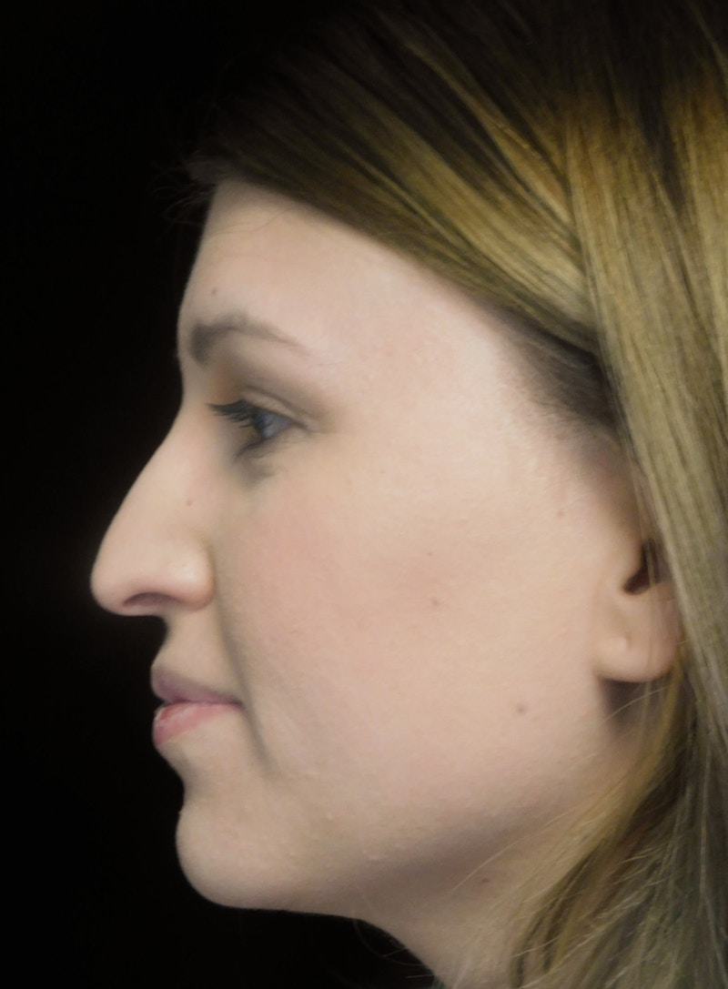 Beverly Hills Rhinoplasty Before & After Gallery - Patient 244001 - Image 13 Dr. Deepak Raj Dugar
