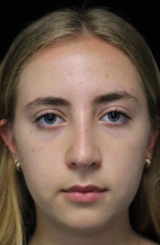 Beverly Hills Rhinoplasty Before & After Gallery - Patient 410606 - Image 4 Dr. Deepak Raj Dugar