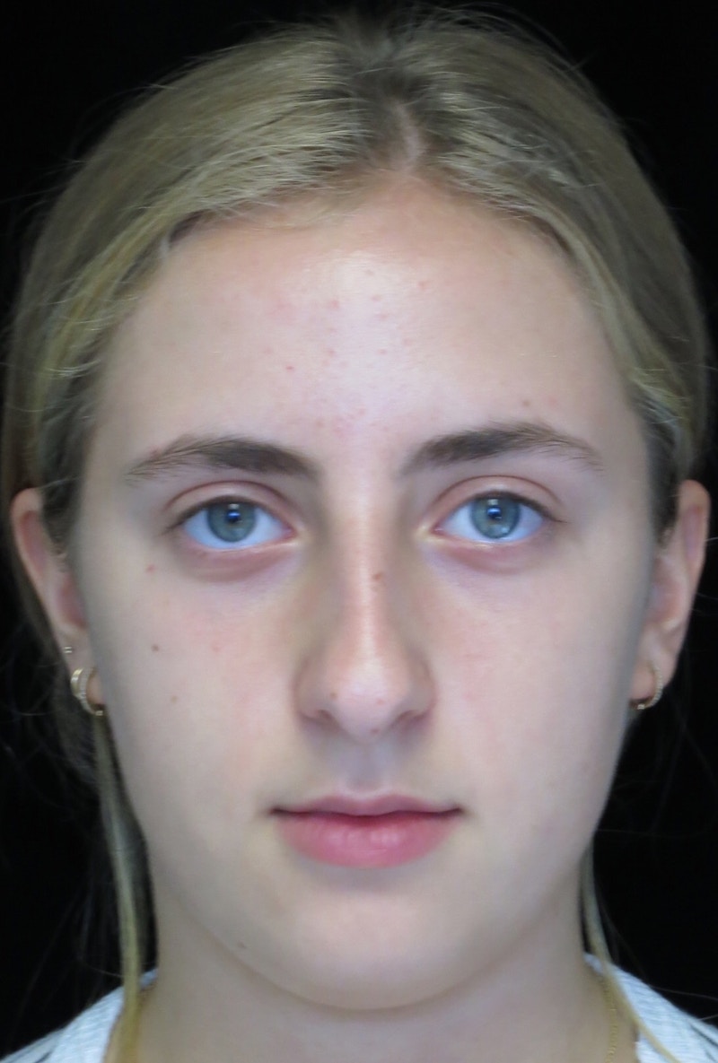 Beverly Hills Rhinoplasty Before & After Gallery - Patient 410606 - Image 3 Dr. Deepak Raj Dugar