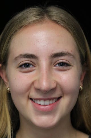 Beverly Hills Rhinoplasty Before & After Gallery - Patient 410606 - Image 6 Dr. Deepak Raj Dugar