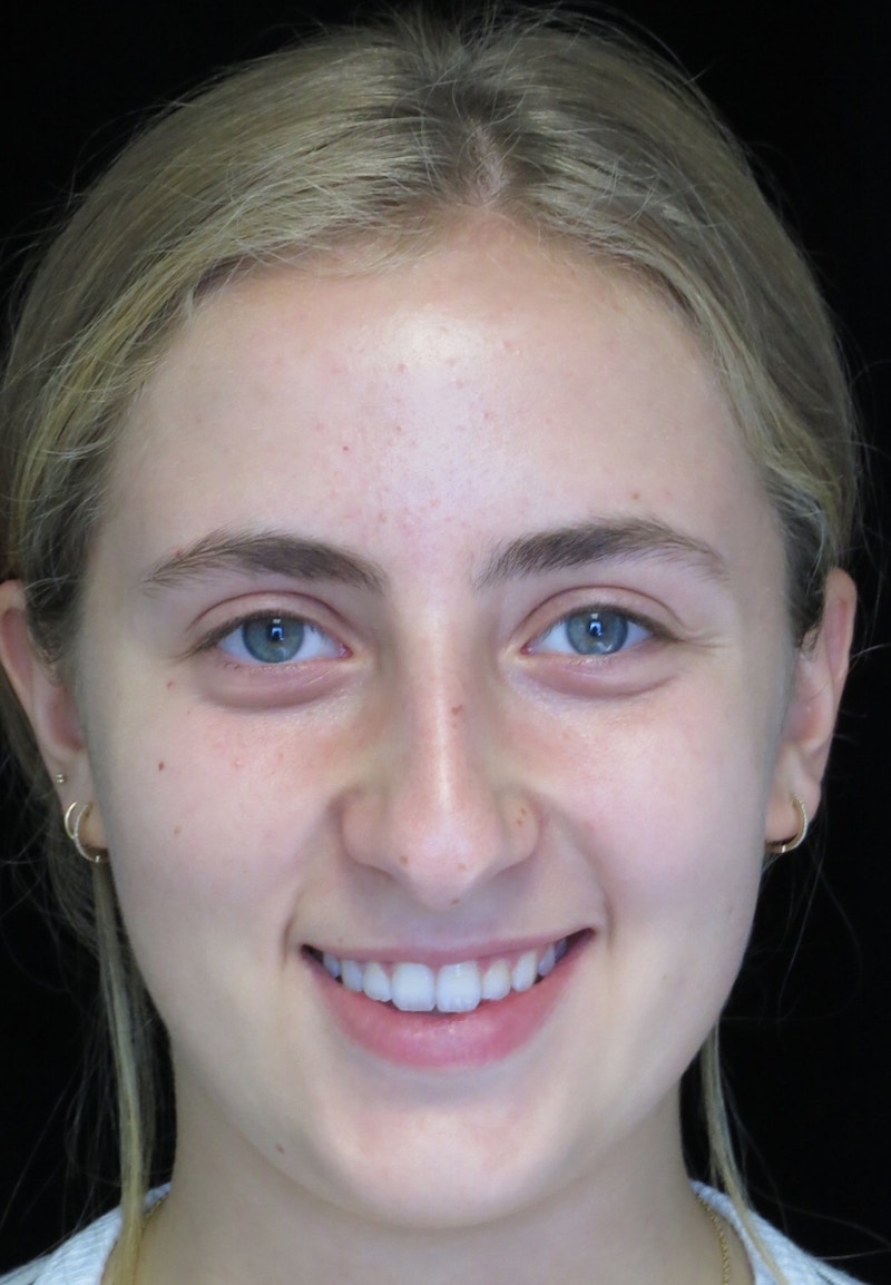 Beverly Hills Rhinoplasty Before & After Gallery - Patient 410606 - Image 5 Dr. Deepak Raj Dugar