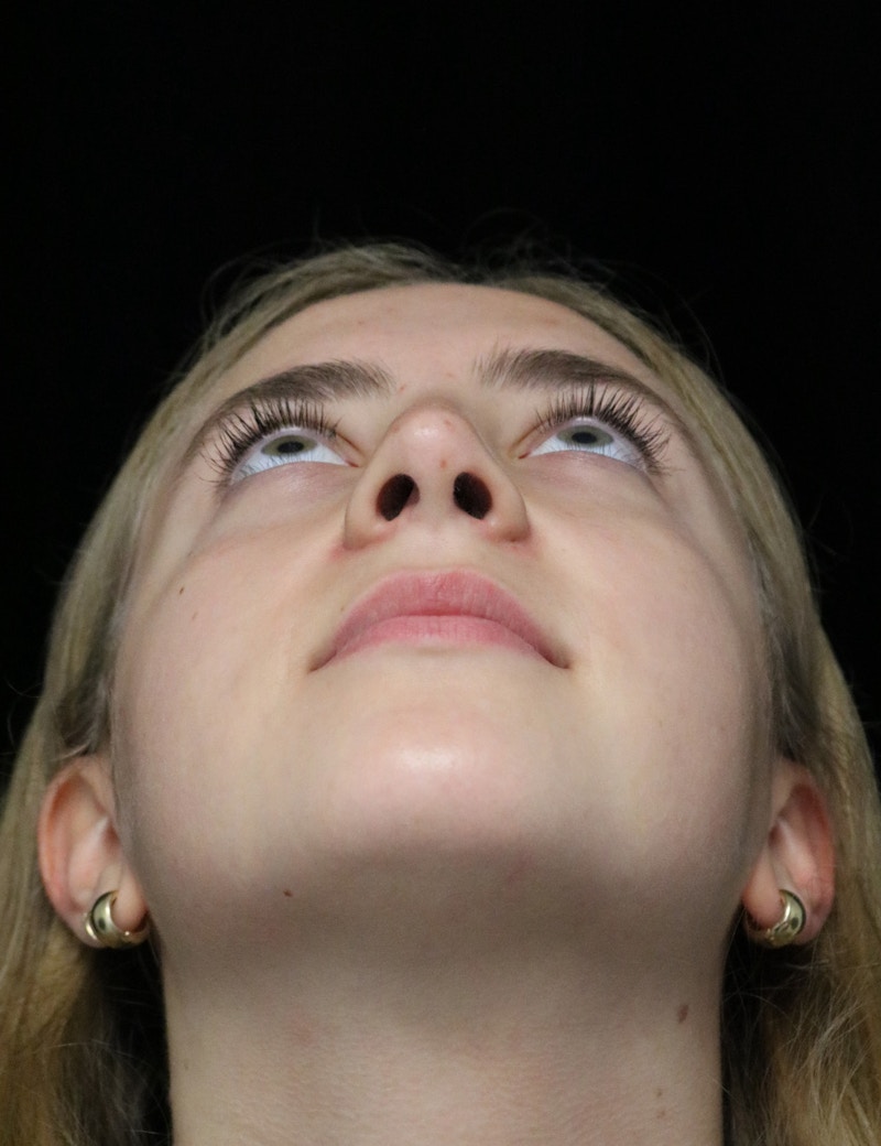 Beverly Hills Rhinoplasty Before & After Gallery - Patient 410606 - Image 8 Dr. Deepak Raj Dugar