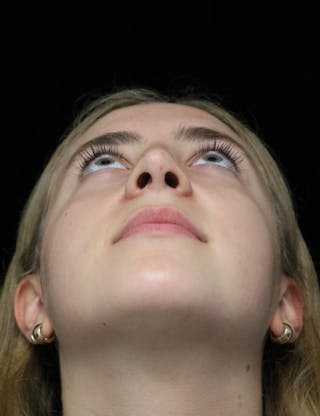 Beverly Hills Rhinoplasty Before & After Gallery - Patient 410606 - Image 8 Dr. Deepak Raj Dugar