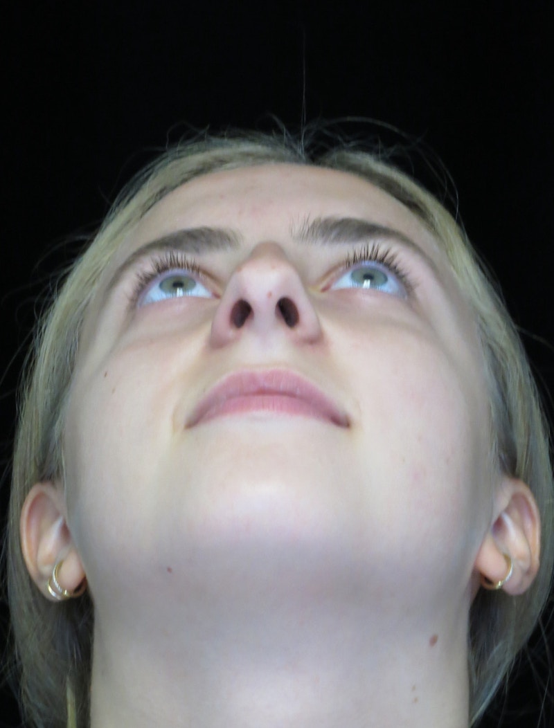 Beverly Hills Rhinoplasty Before & After Gallery - Patient 410606 - Image 7 Dr. Deepak Raj Dugar