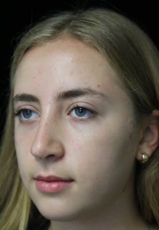 Beverly Hills Rhinoplasty Before & After Gallery - Patient 410606 - Image 10 Dr. Deepak Raj Dugar