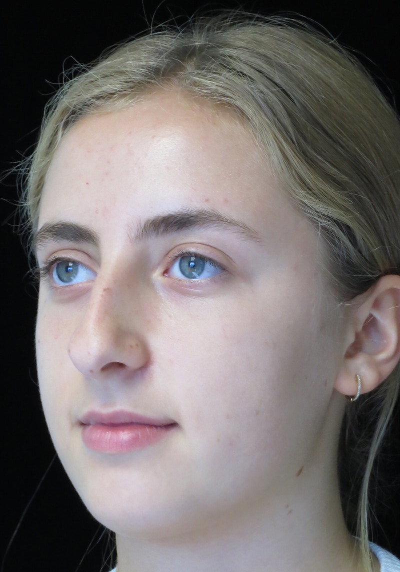 Beverly Hills Rhinoplasty Before & After Gallery - Patient 410606 - Image 9 Dr. Deepak Raj Dugar