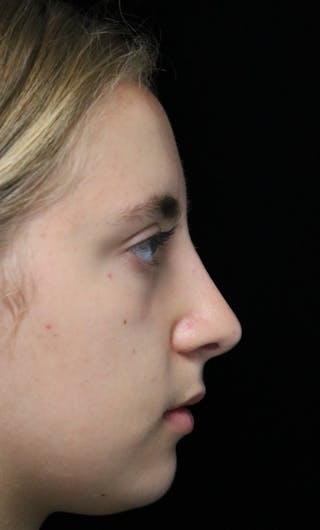 Beverly Hills Rhinoplasty Before & After Gallery - Patient 410606 - Image 2 Dr. Deepak Raj Dugar
