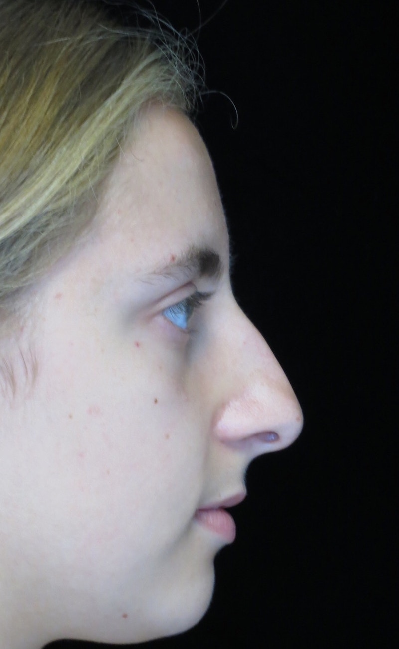 Beverly Hills Rhinoplasty Before & After Gallery - Patient 410606 - Image 1 Dr. Deepak Raj Dugar