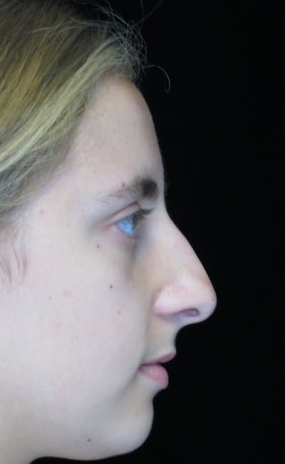 Beverly Hills Rhinoplasty Before & After Gallery - Patient 410606 - Image 1 Dr. Deepak Raj Dugar
