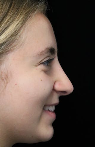 Beverly Hills Rhinoplasty Before & After Gallery - Patient 410606 - Image 12 Dr. Deepak Raj Dugar
