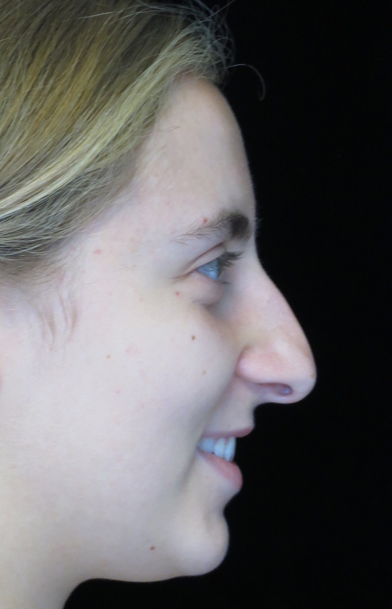Beverly Hills Rhinoplasty Before & After Gallery - Patient 410606 - Image 11 Dr. Deepak Raj Dugar