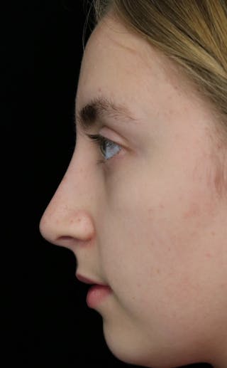 Beverly Hills Rhinoplasty Before & After Gallery - Patient 410606 - Image 14 Dr. Deepak Raj Dugar