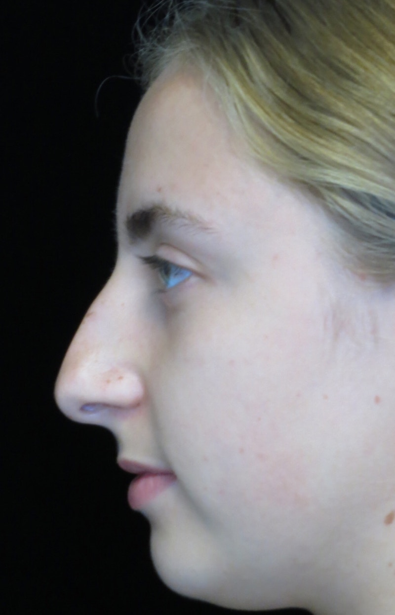 Beverly Hills Rhinoplasty Before & After Gallery - Patient 410606 - Image 13 Dr. Deepak Raj Dugar