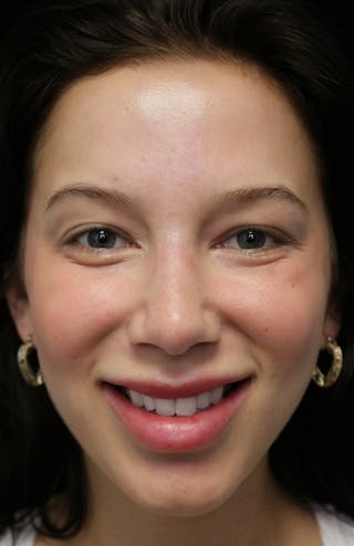 Beverly Hills Rhinoplasty Before & After Gallery - Patient 241548 - Image 4 Dr. Deepak Raj Dugar