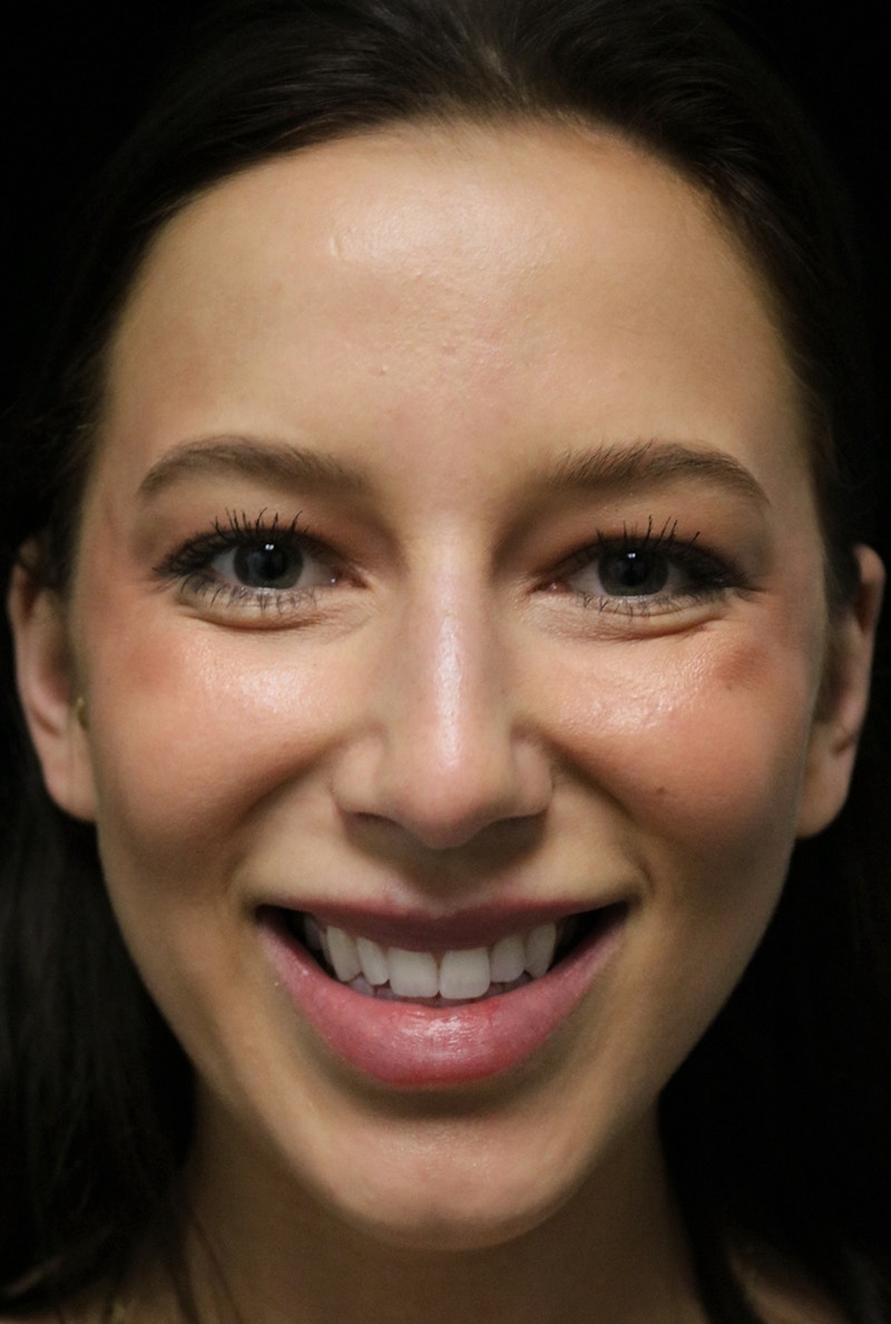 Beverly Hills Rhinoplasty Before & After Gallery - Patient 241548 - Image 3 Dr. Deepak Raj Dugar