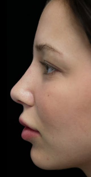 Beverly Hills Rhinoplasty Before & After Gallery - Patient 241548 - Image 6 Dr. Deepak Raj Dugar