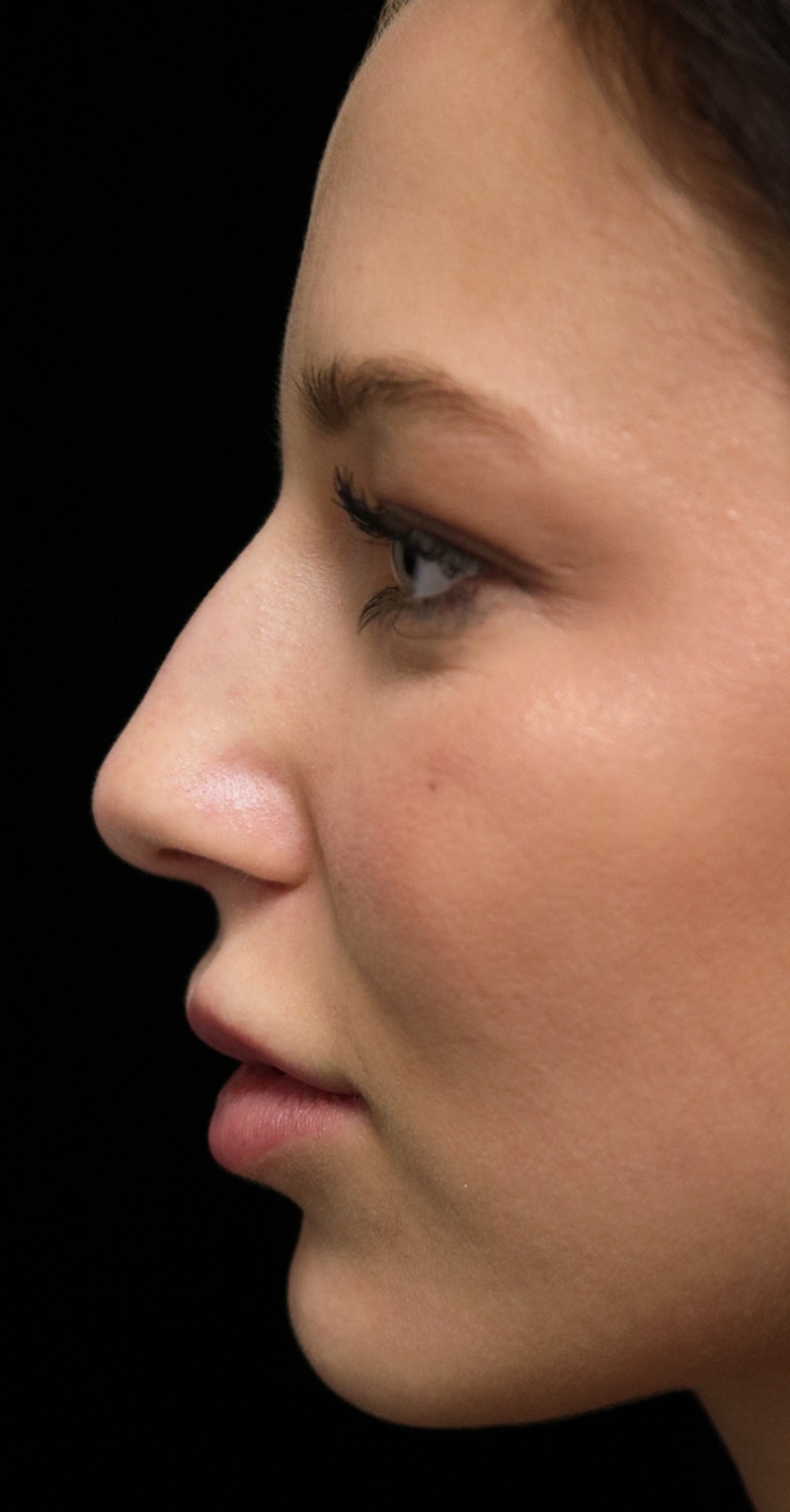 Beverly Hills Rhinoplasty Before & After Gallery - Patient 241548 - Image 5 Dr. Deepak Raj Dugar