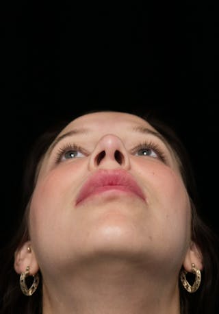 Beverly Hills Rhinoplasty Before & After Gallery - Patient 241548 - Image 8 Dr. Deepak Raj Dugar