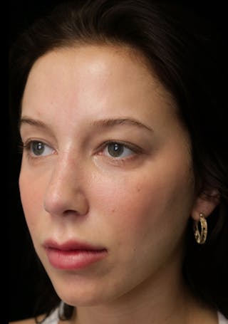 Beverly Hills Rhinoplasty Before & After Gallery - Patient 241548 - Image 10 Dr. Deepak Raj Dugar