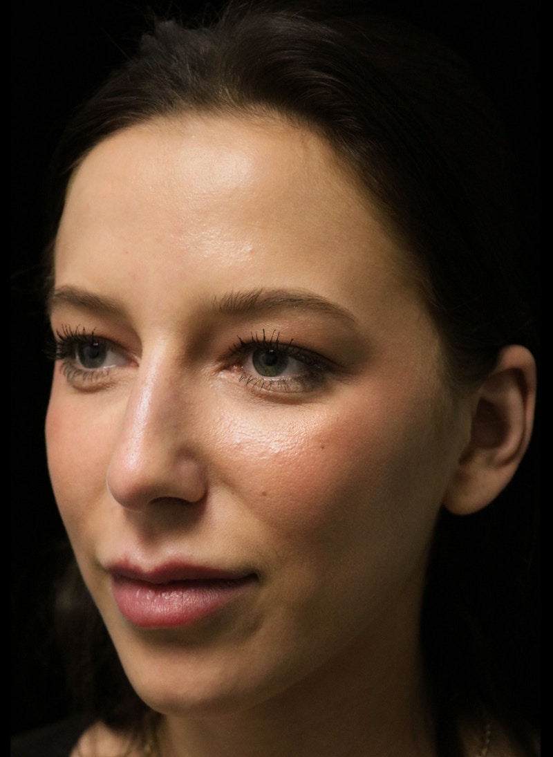 Beverly Hills Rhinoplasty Before & After Gallery - Patient 241548 - Image 9 Dr. Deepak Raj Dugar