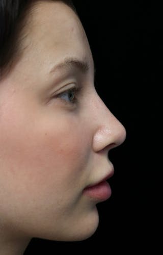 Beverly Hills Rhinoplasty Before & After Gallery - Patient 241548 - Image 2 Dr. Deepak Raj Dugar
