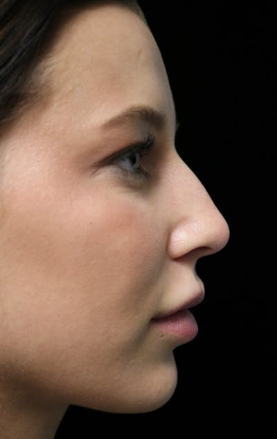Beverly Hills Rhinoplasty Before & After Gallery - Patient 241548 - Image 1 Dr. Deepak Raj Dugar