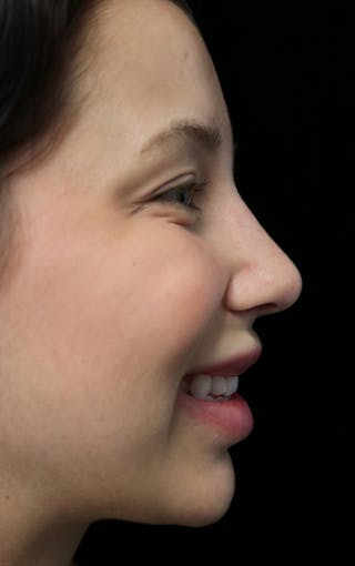 Beverly Hills Rhinoplasty Before & After Gallery - Patient 241548 - Image 12 Dr. Deepak Raj Dugar
