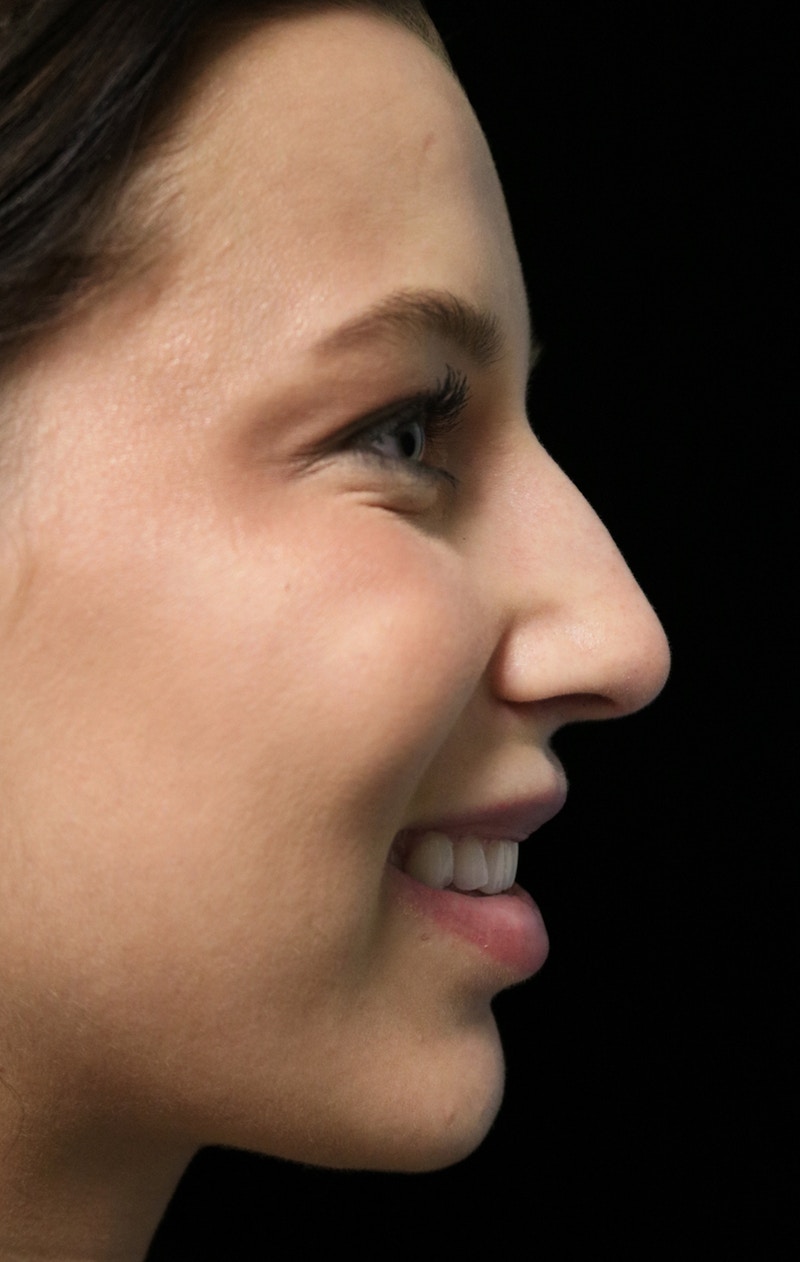 Beverly Hills Rhinoplasty Before & After Gallery - Patient 241548 - Image 11 Dr. Deepak Raj Dugar