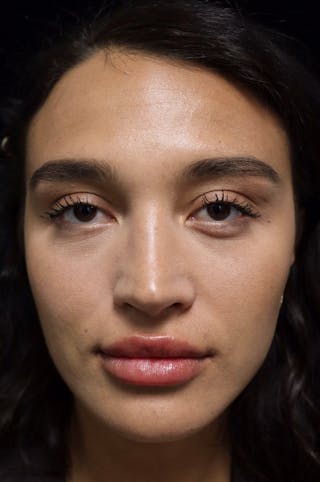 Beverly Hills Rhinoplasty Before & After Gallery - Patient 324304 - Image 4 Dr. Deepak Raj Dugar