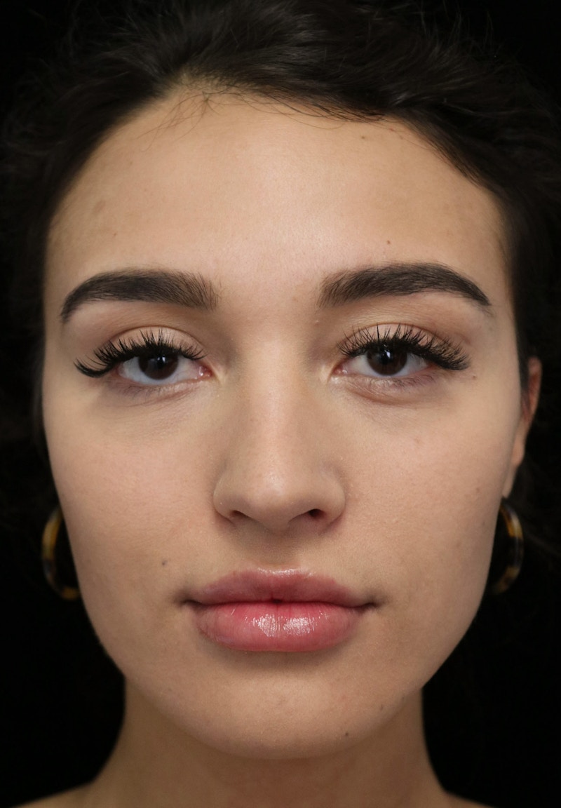Beverly Hills Rhinoplasty Before & After Gallery - Patient 324304 - Image 3 Dr. Deepak Raj Dugar