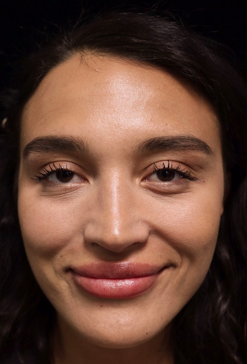 Beverly Hills Rhinoplasty Before & After Gallery - Patient 324304 - Image 6 Dr. Deepak Raj Dugar