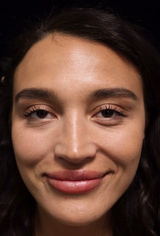 Beverly Hills Rhinoplasty Before & After Gallery - Patient 324304 - Image 6 Dr. Deepak Raj Dugar