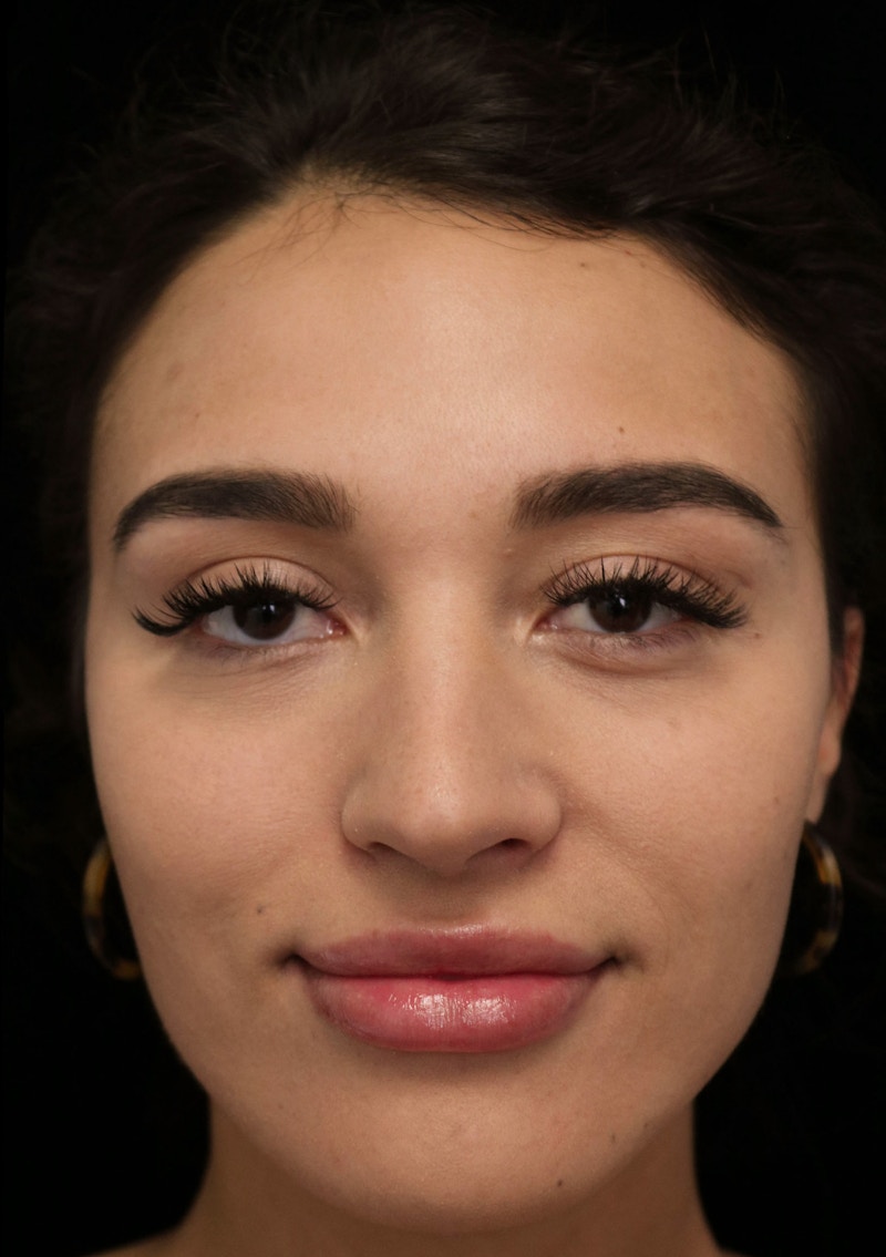 Beverly Hills Rhinoplasty Before & After Gallery - Patient 324304 - Image 5 Dr. Deepak Raj Dugar