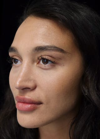 Beverly Hills Rhinoplasty Before & After Gallery - Patient 324304 - Image 10 Dr. Deepak Raj Dugar