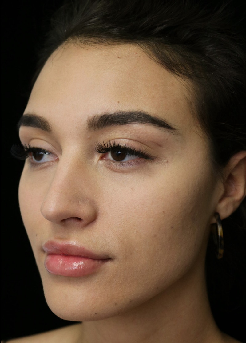 Beverly Hills Rhinoplasty Before & After Gallery - Patient 324304 - Image 9 Dr. Deepak Raj Dugar