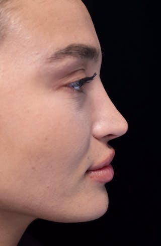 Beverly Hills Rhinoplasty Before & After Gallery - Patient 324304 - Image 2 Dr. Deepak Raj Dugar