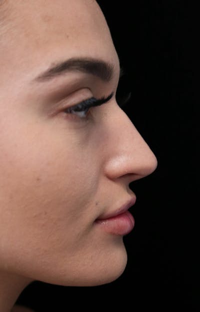 Beverly Hills Rhinoplasty Before & After Gallery - Patient 324304 - Image 1 Dr. Deepak Raj Dugar