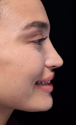 Beverly Hills Rhinoplasty Before & After Gallery - Patient 324304 - Image 12 Dr. Deepak Raj Dugar