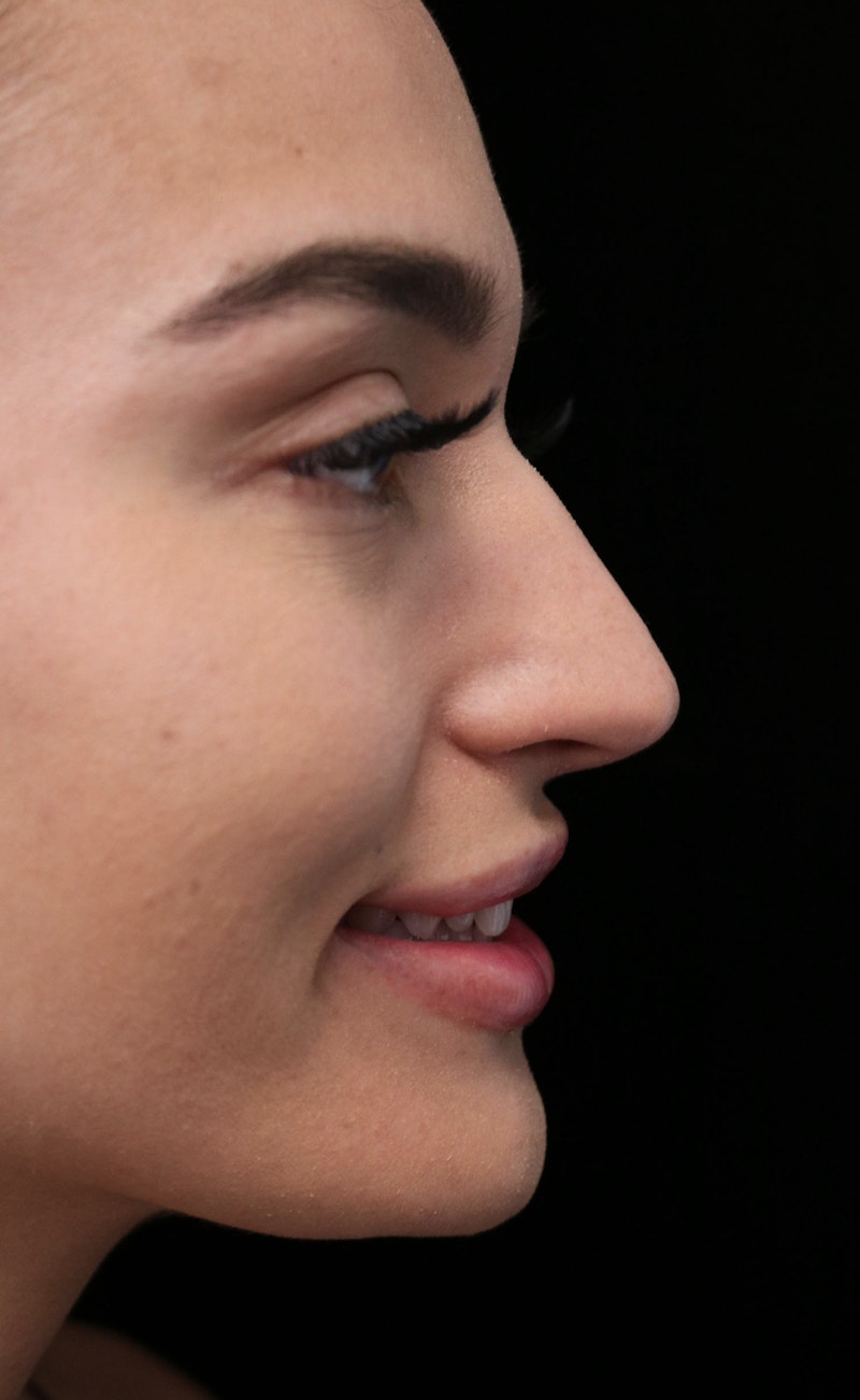 Beverly Hills Rhinoplasty Before & After Gallery - Patient 324304 - Image 11 Dr. Deepak Raj Dugar